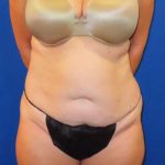 Tummy Tuck Before & After Patient #1190