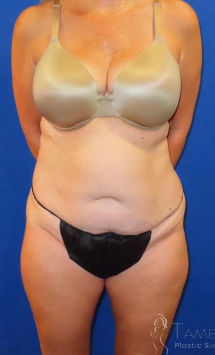 Tummy Tuck Before & After Patient #1190