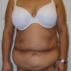 Tummy Tuck Before & After Patient #1214