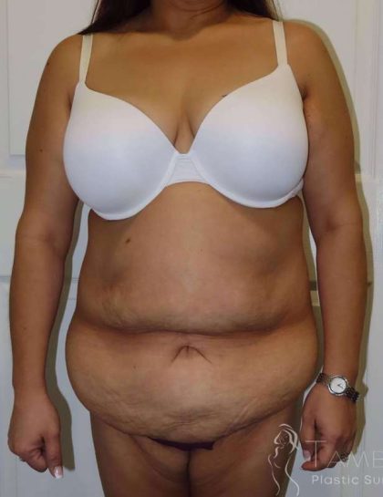 Tummy Tuck Before & After Patient #1214