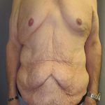 Tummy Tuck Before & After Patient #1225
