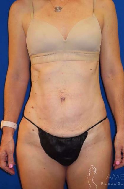 Tummy Tuck Before & After Patient #1236