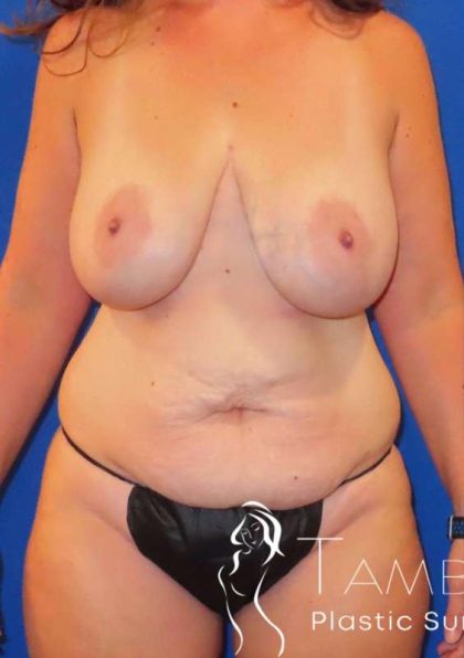 Tummy Tuck Before & After Patient #1260