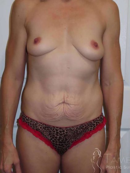Tummy Tuck Before & After Patient #1284