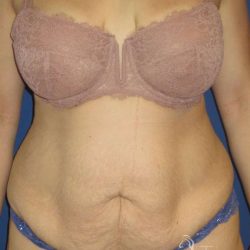 Tummy Tuck Before & After Patient #1293