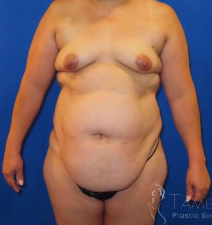 Tummy Tuck Before & After Patient #1317