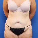 Tummy Tuck Before & After Patient #1343