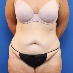 Tummy Tuck Before & After Patient #1343