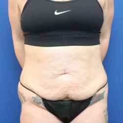 Tummy Tuck Before & After Patient #1369