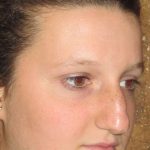 Rhinoplasty Before & After Patient #1406