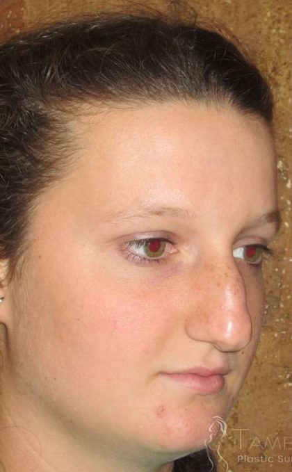 Rhinoplasty Before & After Patient #1406
