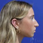 Rhinoplasty Before & After Patient #1415