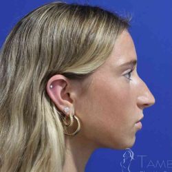 Rhinoplasty Before & After Patient #1415