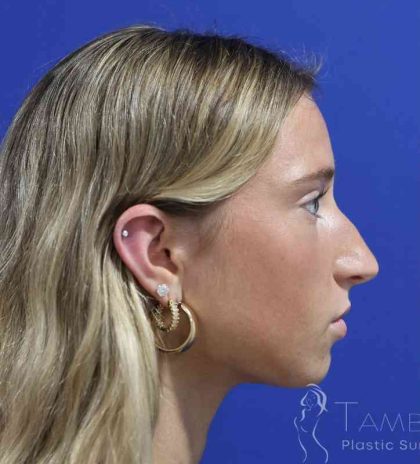 Rhinoplasty Before & After Patient #1415