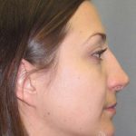 Rhinoplasty Before & After Patient #1424