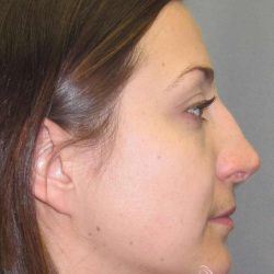 Rhinoplasty Before & After Patient #1424