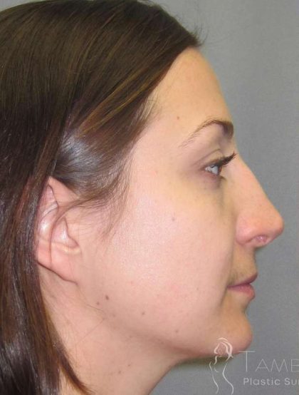 Rhinoplasty Before & After Patient #1424
