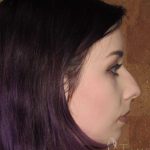 Rhinoplasty Before & After Patient #1439
