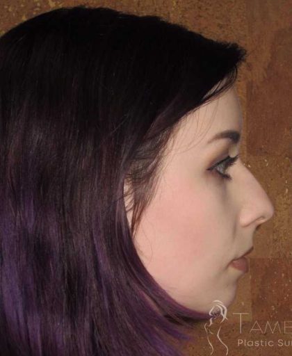 Rhinoplasty Before & After Patient #1439