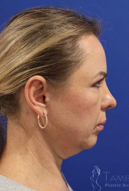 Facelift Before & After Patient #1609