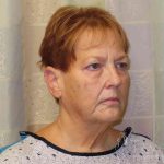 Facelift Before & After Patient #1620