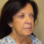 Facelift Before & After Patient #1631