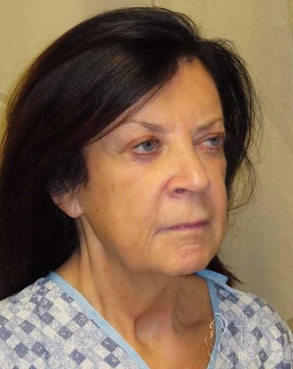 Facelift Before & After Patient #1631