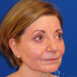 Facelift Before & After Patient #1642