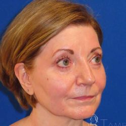 Facelift Before & After Patient #1642