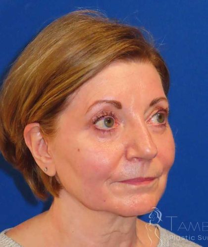 Facelift Before & After Patient #1642