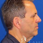 Facelift Before & After Patient #1653