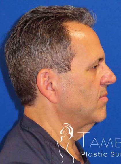 Facelift Before & After Patient #1653