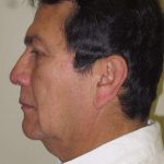 Facelift Before & After Patient #1664
