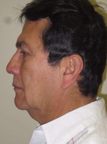 Facelift Before & After Patient #1664