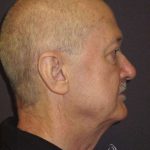 Facelift Before & After Patient #1675