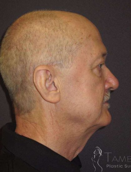 Facelift Before & After Patient #1675