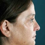 Facelift Before & After Patient #1682