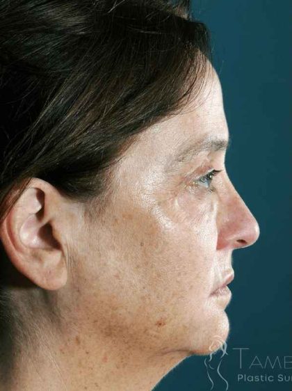 Facelift Before & After Patient #1682