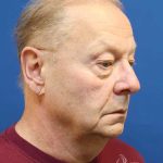 Facelift Before & After Patient #1693