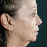 Facelift Before & After Patient #1700