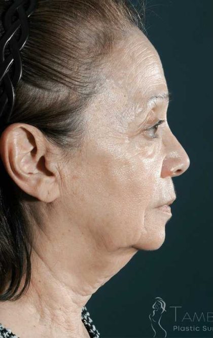 Facelift Before & After Patient #1700