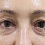 Eyelid Lift Before & After Patient #1708