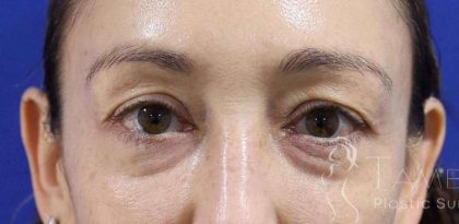 Eyelid Lift Before & After Patient #1708
