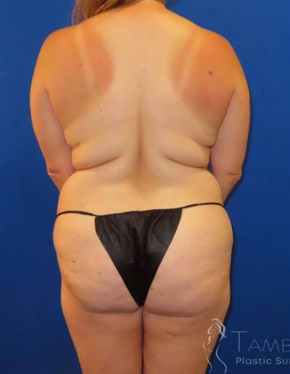 Breast Lift Before & After Patient #1950