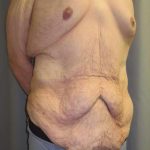 Lower Body Lift Before & After Patient #585