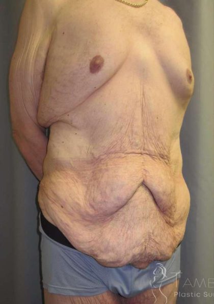 Lower Body Lift Before & After Patient #585