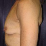 Breast Augmentation Before & After Patient #2054