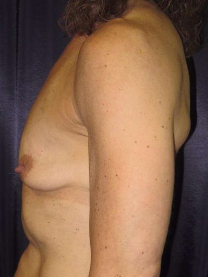 Breast Augmentation Before & After Patient #2054