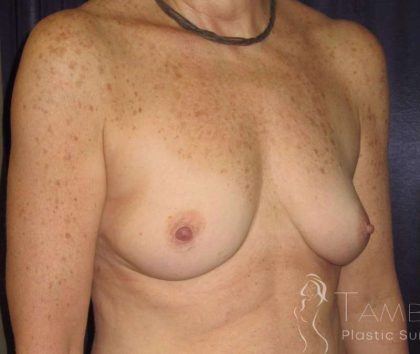 Breast Augmentation Before & After Patient #2063