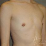 Breast Augmentation Before & After Patient #2081